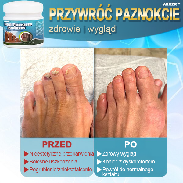 ✨Aexzr™ 5X Szybko leczący grzybicę paznokci Ointment👨🏼‍⚕️British Zatwierdzony przez dermatologa