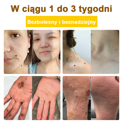 ✅flysmus™ Krem leczniczy z jadem pszczelim🐝: Leczenie egzemy, łuszczycy, trądziku, trądziku różowatego, infekcji grzybiczych, brodawek