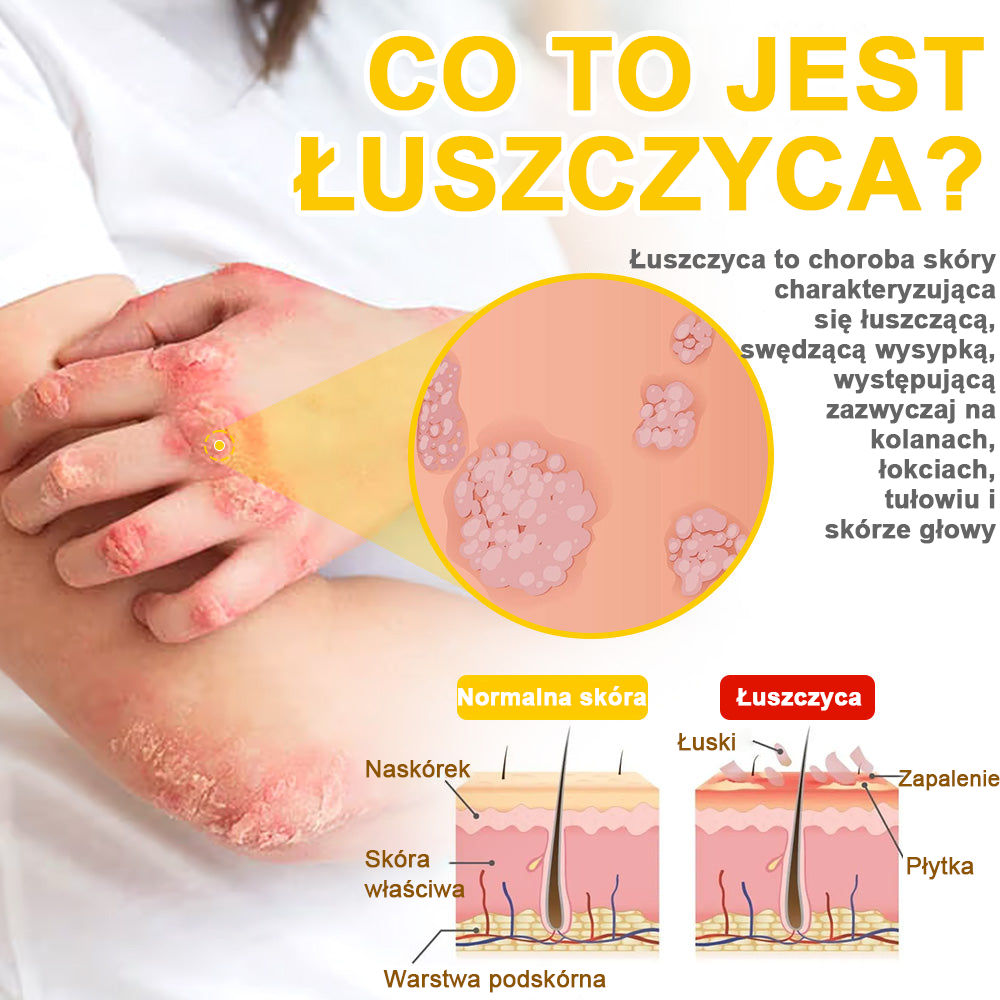 ✅flysmus™ Krem leczniczy z jadem pszczelim🐝: Leczenie egzemy, łuszczycy, trądziku, trądziku różowatego, infekcji grzybiczych, brodawek